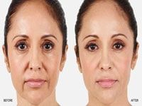 photos avant après lipofilling visage tunisie